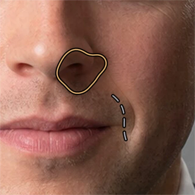 The same close view of the man’s nose and mouth, now marked. A gold outline encloses the small closed shadow beside and below the nostril — the loop. Further down and to the right, a dashed grey line follows the separate smile crease running toward the corner of the mouth. The skin between the two is left unmarked.